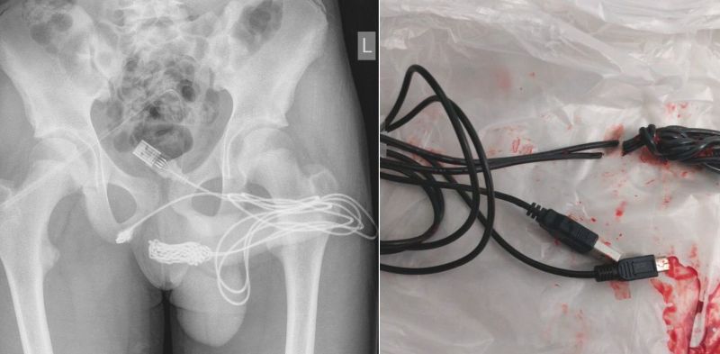 OMG! 15-Year-Old Teen Gets USB Cable Stuck in his Private Parts While Trying to “Measure Insides”