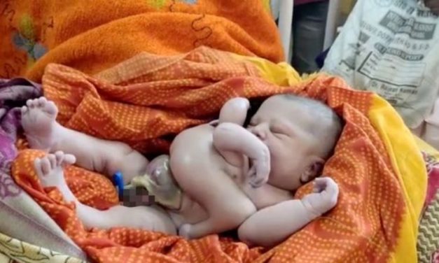 Bihar: Baby Born with Four Legs, Four Arms Attracts Flocks of Visitors, Called God’s Incarnation by People