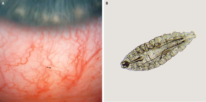 French Gardner’s Itching Eye Turns Out to be Dozens of Fly Larvae in Cornea