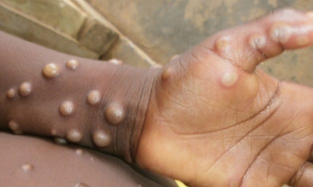 Monkeypox Crisis India – After Confirmed Cases from 12 Countries, India to Screen International Arrivals