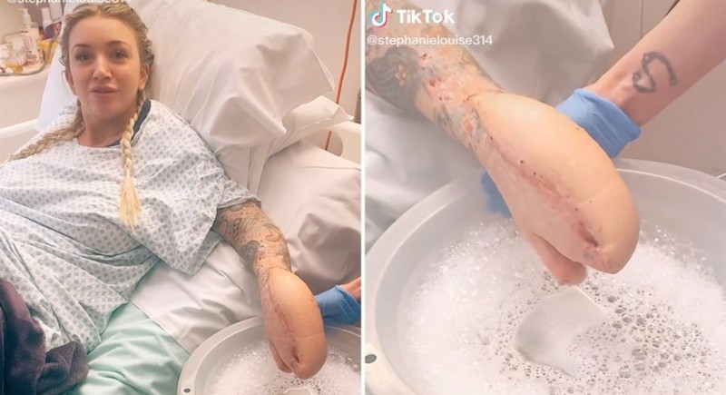 UK: Woman Survives Sepsis and Trades her Fingers to Get “Shark Hand” for Self