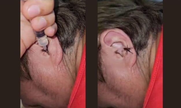 Video of Live Spider Crawling Out From Man’s Ear; Netizens Shocked